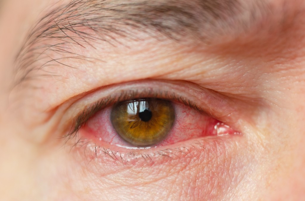 Redness, itching, swelling and a gritty feeling are just some of the symptoms of pink eye. Here is a close-up of the bloodshot eyes.