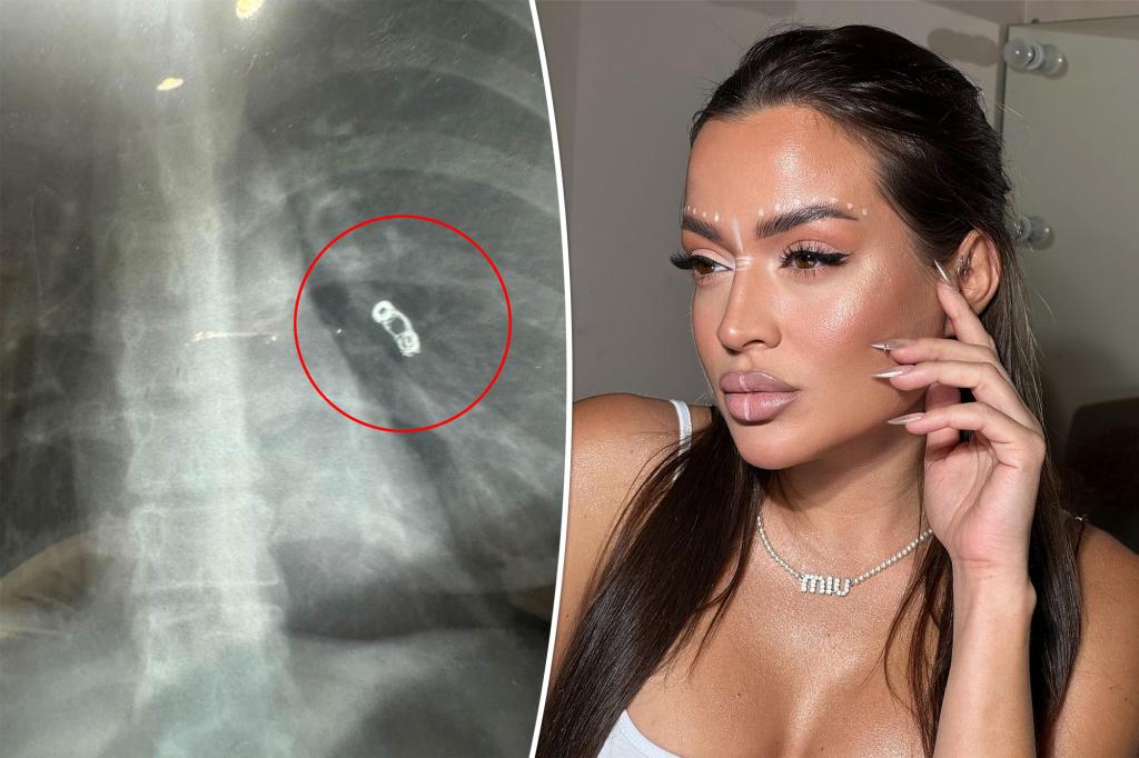 The influencer thought she had a cold - an X-ray revealed a previous surgical mishap: 'They said I could die any second'