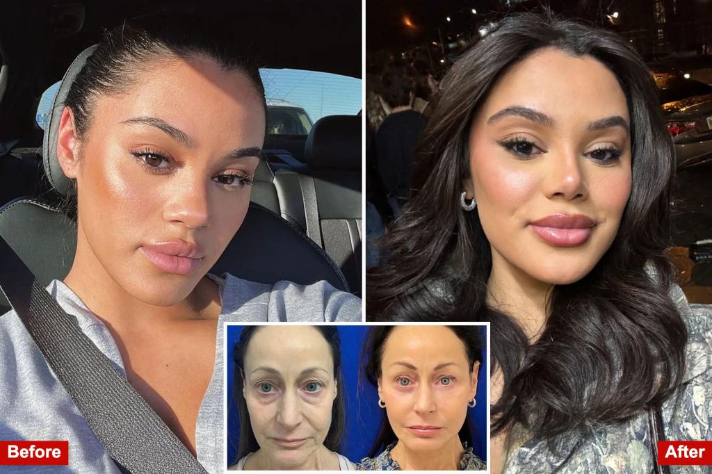 Exclusive | 'Face BBLs' Can Undo Horrible Ozempic Side Effect - And People Are Spending Thousands: 'Now I Can Look In The Mirror'