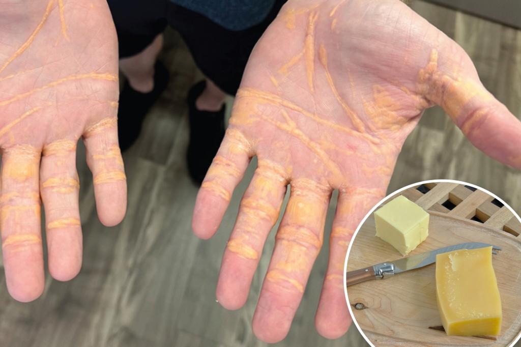 Shocking image shows what happened with a man's hands when he ate only cheese, beef and butter sticks for 8 months