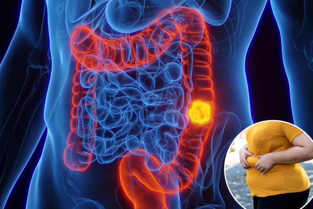 New study reveals biggest risk factor for colon cancer in under-35s - and it will shock you