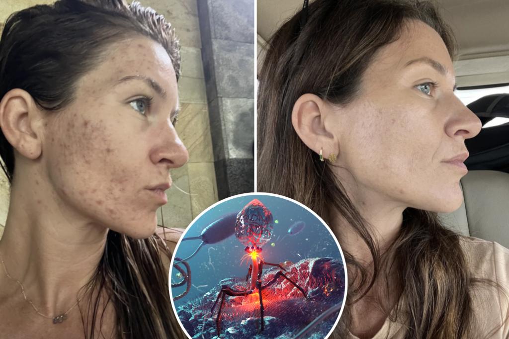 Can a virus finally clean your acne? New 'infecting' bacteria of skincare that causes acne - and is supported by Ryan Reynolds