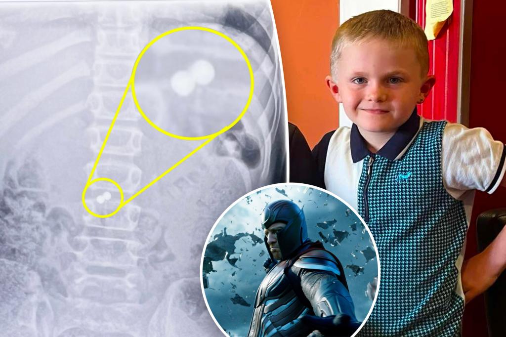 The boy swallowed toy magnet, becomes X-Men's Magneto in strange accident: 'he exploded crying'