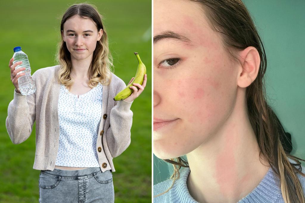 Woman's allergy woman, the woman says being in the rain make her want to 'chop my skin with a knife'