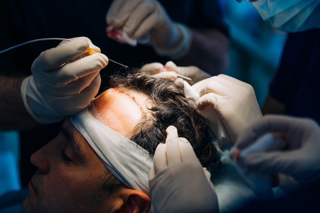 The surgeon who performs a hair transplant operation on a bandage head