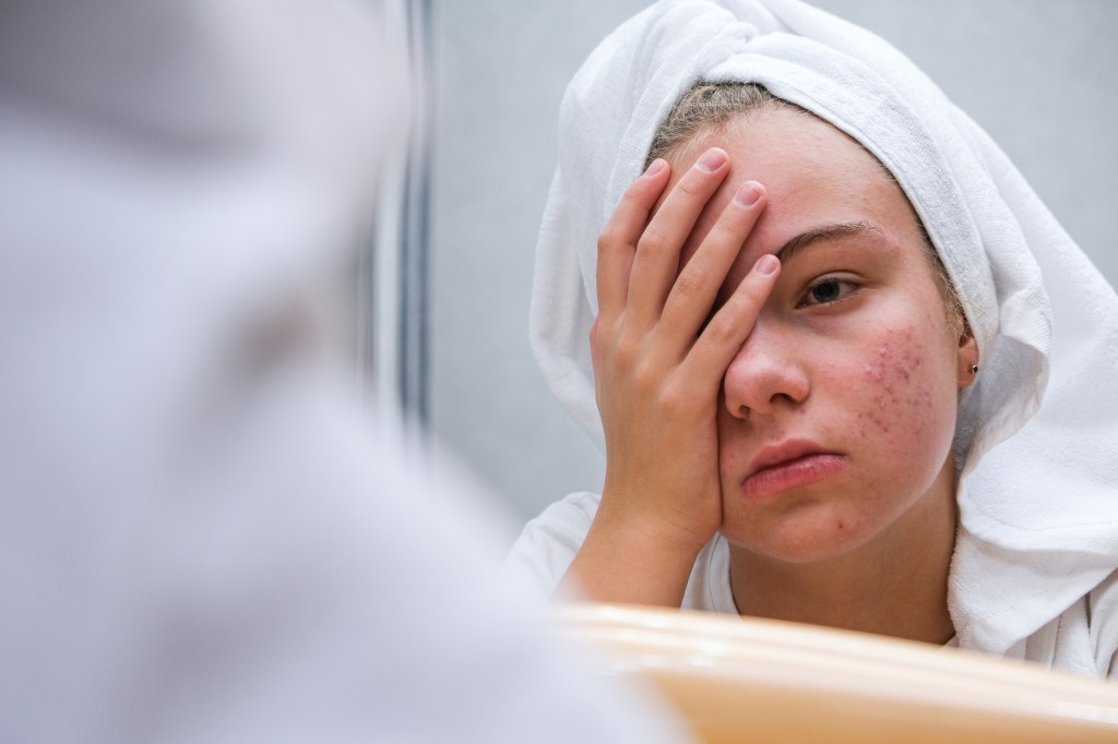 The girl looks frustrated with acne on her face